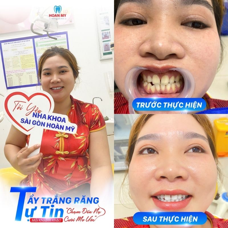 Kết quả tẩy trắng răng tại Hoàn Mỹ Sài Gòn