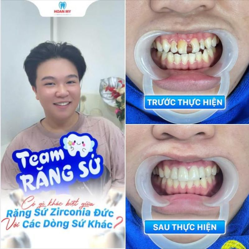 Hình ảnh khách hàng bọc răng sứ tại nha khoa Hoàn Mỹ Sài Gòn