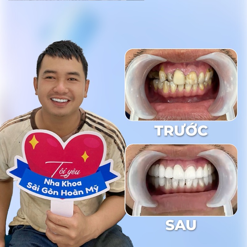 Hình ảnh khách hàng bọc sứ thẩm mỹ tại Hoàn Mỹ Sài Gòn