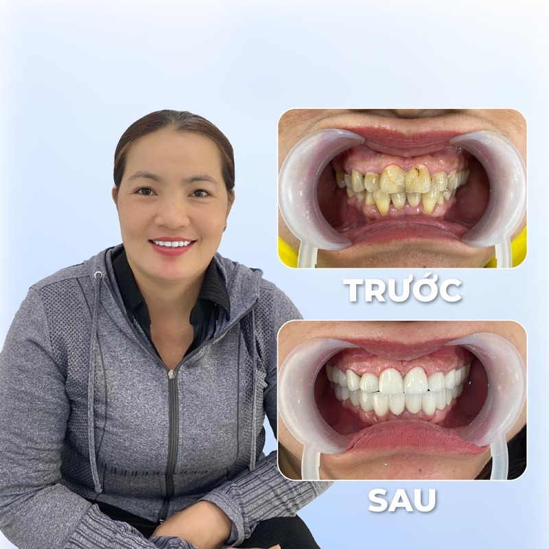 Hình ảnh khách hàng bọc răng sứ tại nha khoa Hoàn Mỹ Sài Gòn