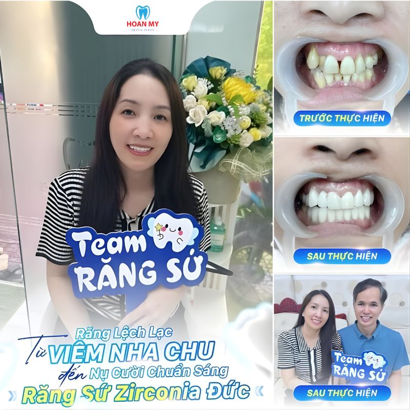 Hình ảnh khách hàng điều trị nha chu kết hợp bọc răng sứ tại Hoàn Mỹ Sài Gòn