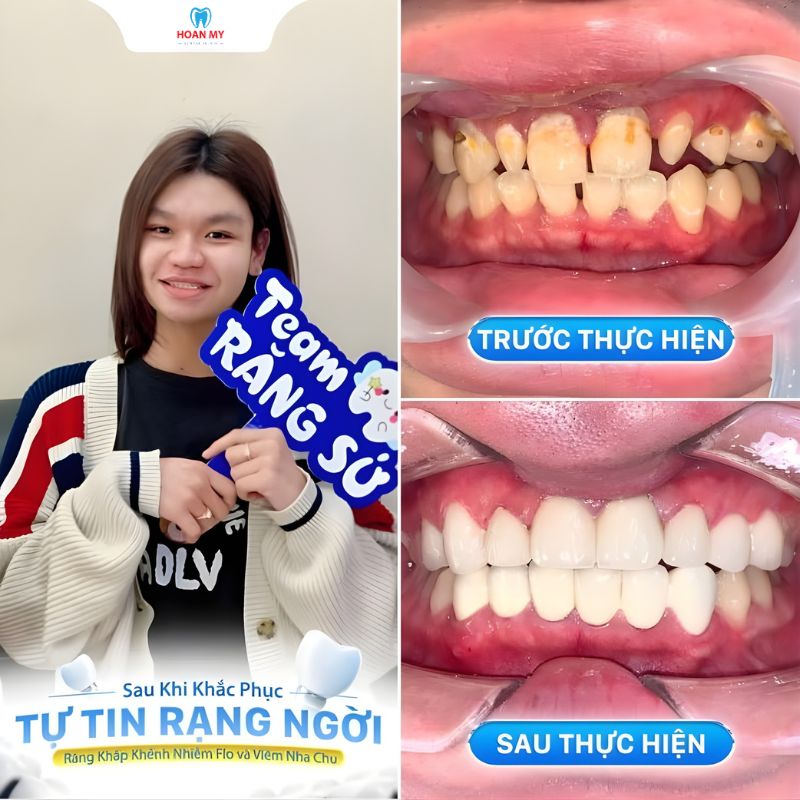 Hình ảnh khách hàng điều trị nha chu và bọc răng sứ tại Hoàn Mỹ Sài Gòn