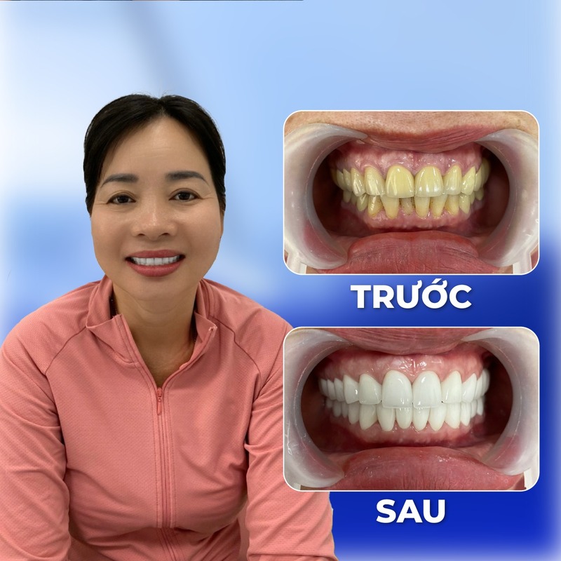 Khách hàng bọc răng sứ thẩm mỹ