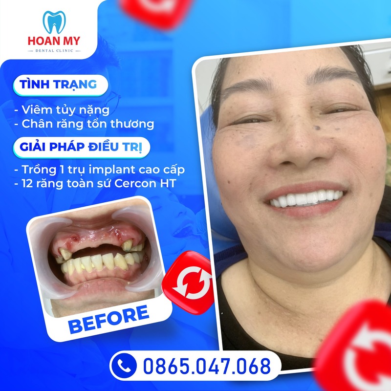Hình ảnh khách hàng thực hiện trồng răng implant và bọc răng sứ tại Hoàn Mỹ Sài Gòn