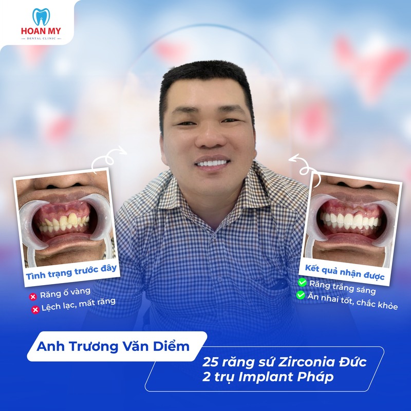 Hình ảnh khách hàng thực hiện trồng răng implant và bọc răng sứ tại Hoàn Mỹ Sài Gòn
