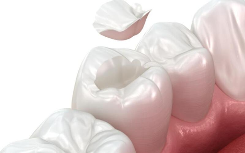 khi nào cần trám răng tạm thời