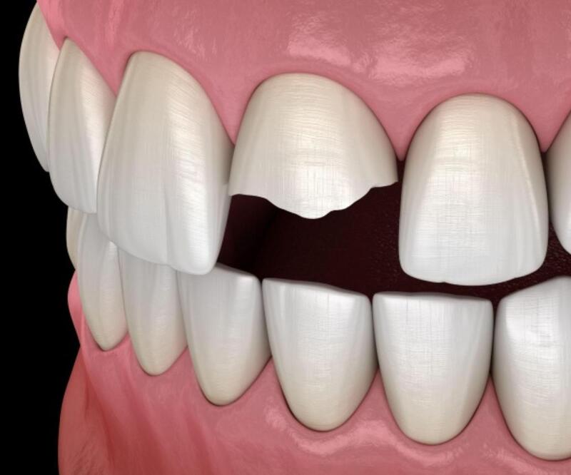 khi nào cần trám răng