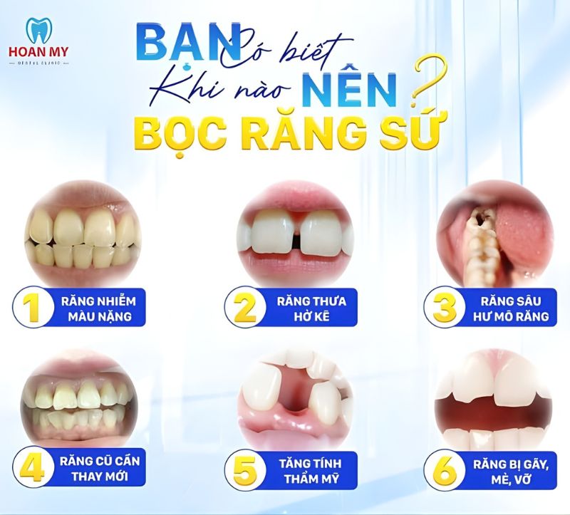 khi nào nên bọc răng sứ thẩm mỹ