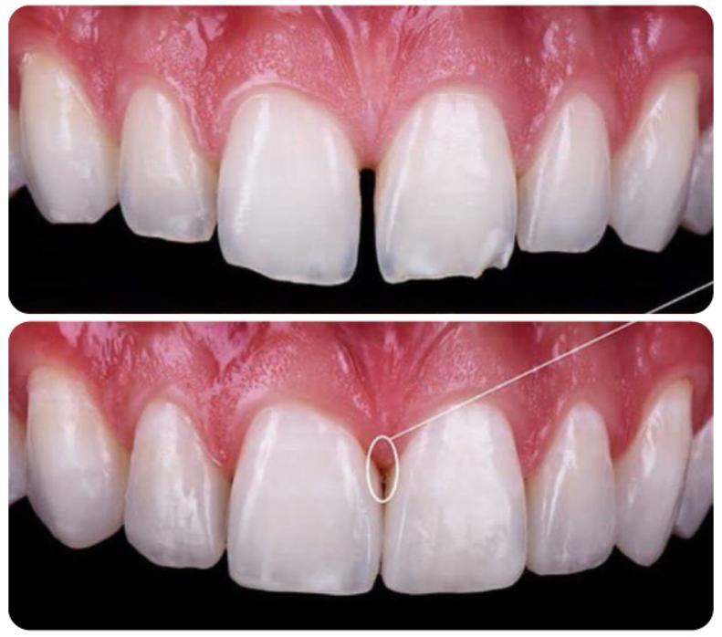 Trám răng thưa bằng vật liệu Composite bền, đẹp tự nhiên