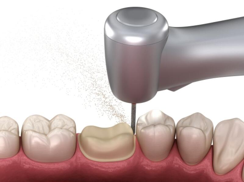 mài răng sứ có đau không