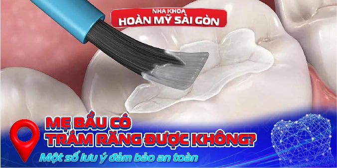 Mẹ bầu có trám răng được không