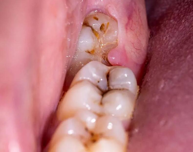 Răng khôn bị sâu là bệnh lý thường gặp do nhiều nguyên nhân