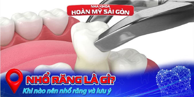 nhổ răng là gì