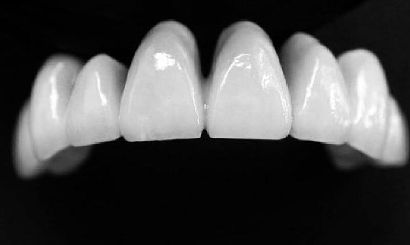 Răng sứ Cercon HT màu trắng đục