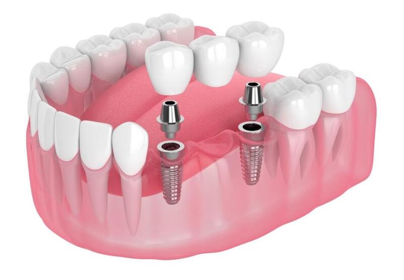 Phục hình răng sứ trên implant