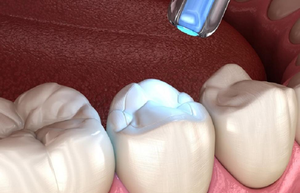 Trám răng có thể duy trì 7 - 9 năm là hoàn toàn bình thường