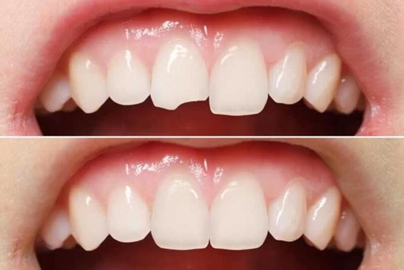 quy trình trám răng mẻ