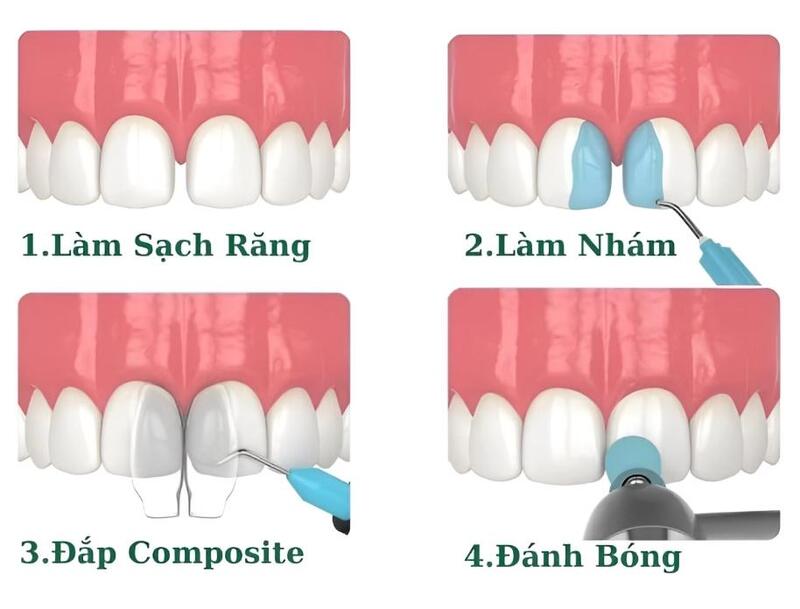 Quy trình trám răng thưa diễn ra nhanh chóng