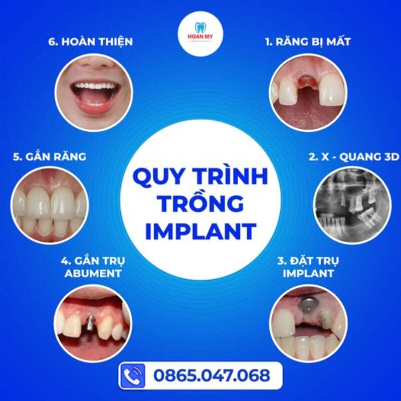 quy trình trồng răng implant