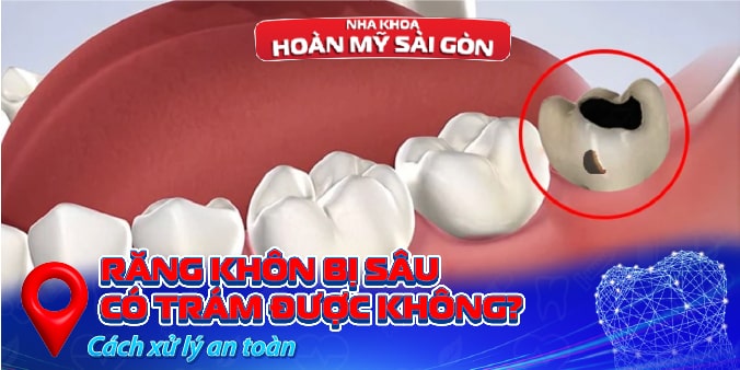 răng khôn bị sâu có trám được không