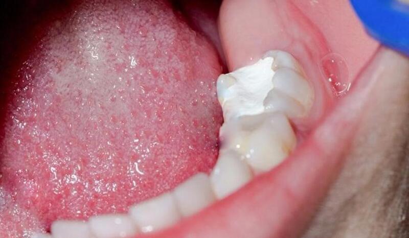 Răng sâu nhẹ, mọc thẳng vẫn có thể thực hiện trám răng