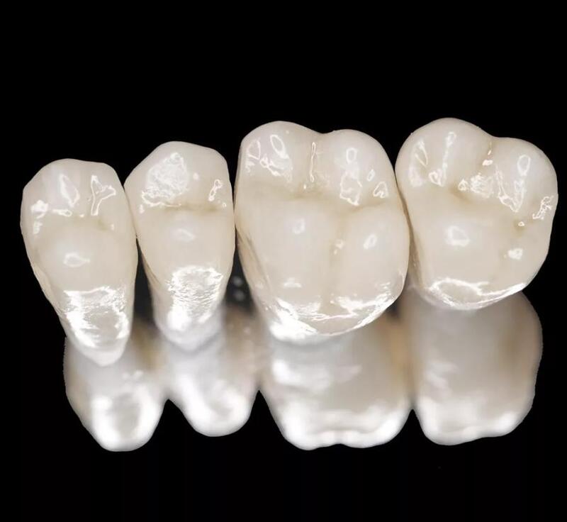 răng sứ kim loại có tốt không