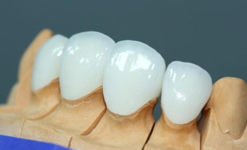 Răng sứ Lava là răng toàn sứ cao cấp làm từ sứ Zirconia tinh khiết