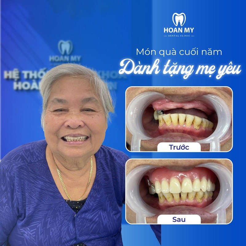 Khách hàng sử dụng dịch vụ răng giả tháo lắp tại Hoàn Mỹ Sài Gòn