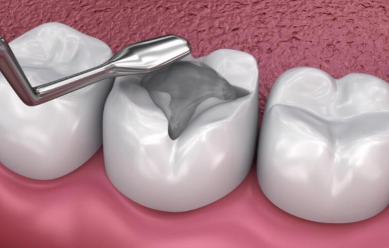 Trám phòng ngừa giúp ngăn ngừa vi khuẩn có thể tấn công gây sâu răng