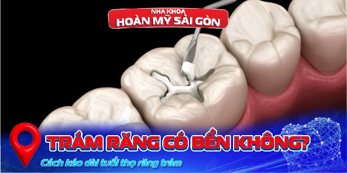 trám răng có bền không