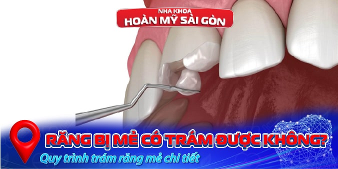 trám răng mẻ