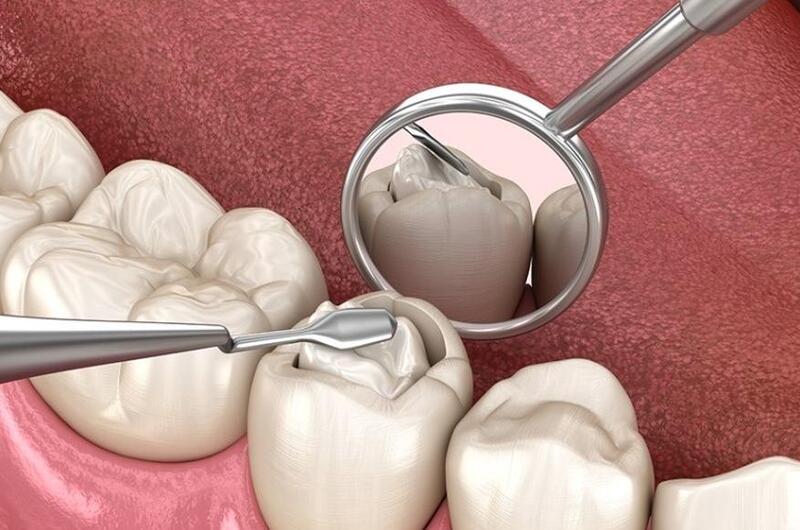 trám răng sâu bao nhiêu tiền