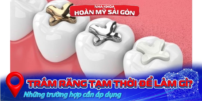 Trám răng tạm thời để làm gì