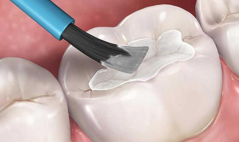 trám răng tạm thời giữ được bao lâu