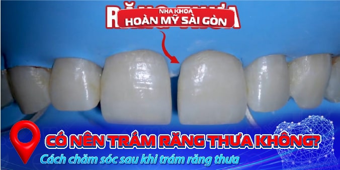 trám răng thưa