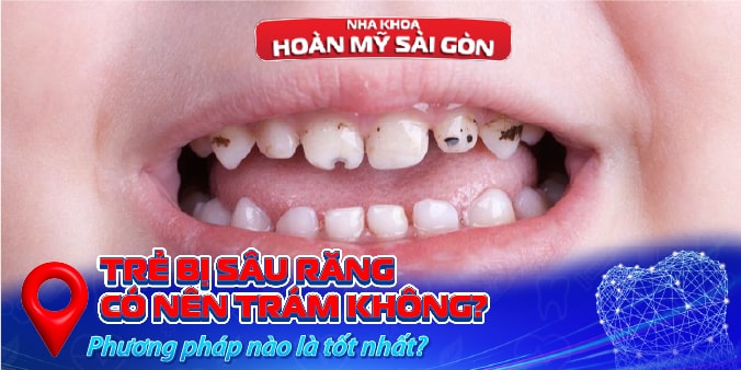 Trẻ bị sâu răng có nên trám không