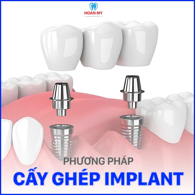 trồng răng implant là gì