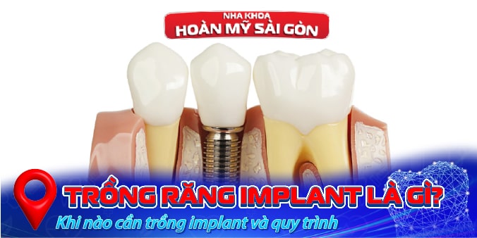 Trồng răng implant