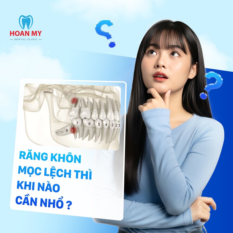 trường hợp nào nên nhổ răng khôn