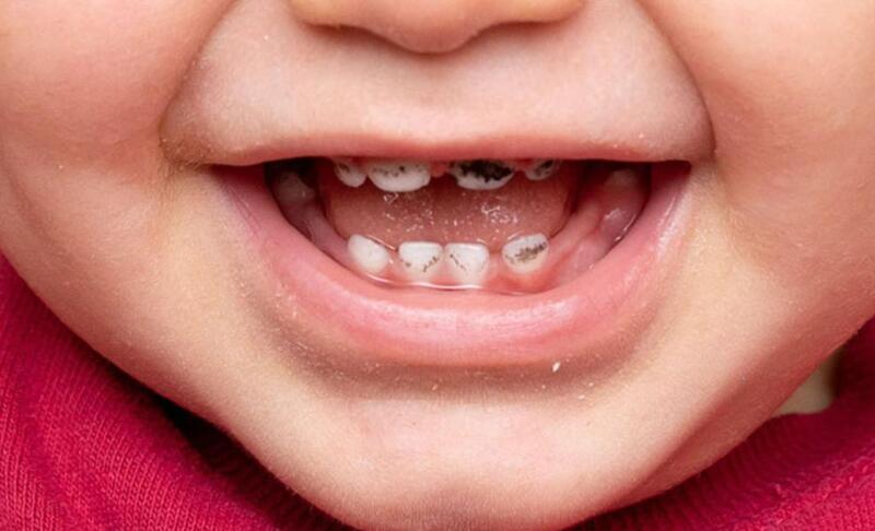 Khi thấy con có dấu hiệu nứt mẻ hoặc sâu, ba mẹ nên cho con thăm khám để có giải pháp điều trị phù hợp