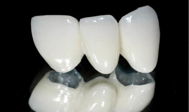 ưu điểm của răng sứ kim loại