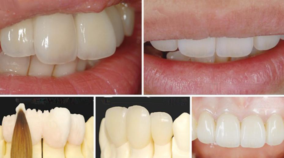 Răng sứ Mỹ có nhiều ưu điểm vượt trội