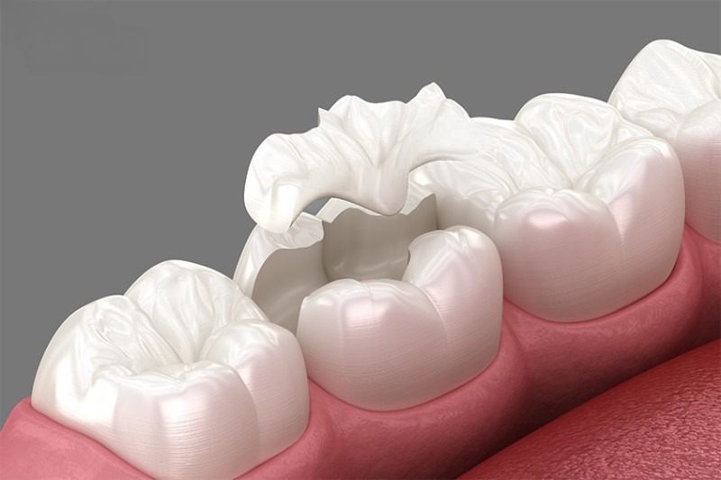 ưu điểm của việc hàn răng