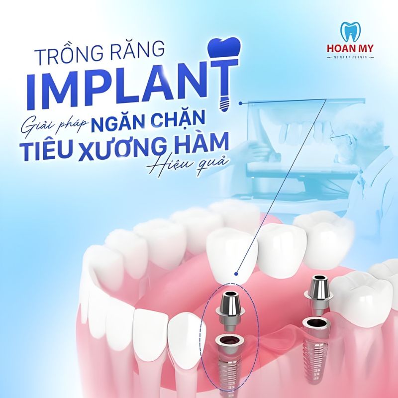 ưu điểm của việc trồng răng implant
