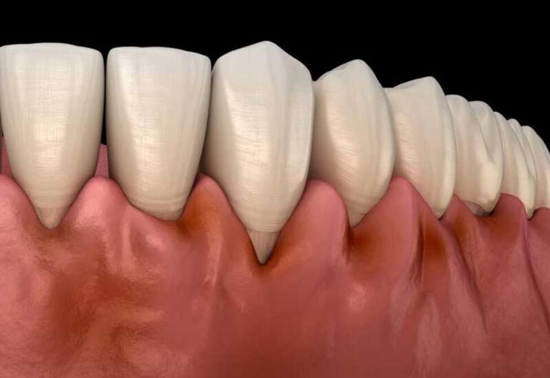 viêm nha chu có nguy hiểm không