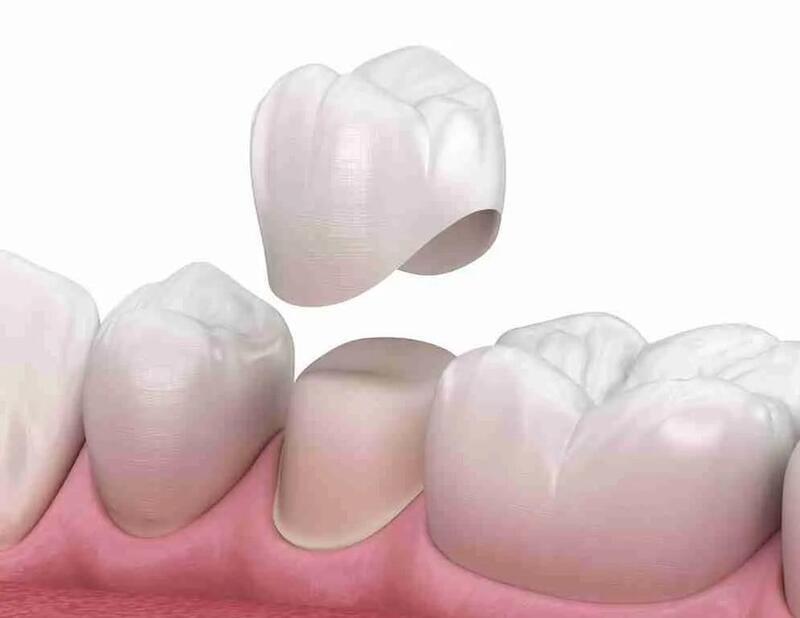 quy trình bọc răng sứ