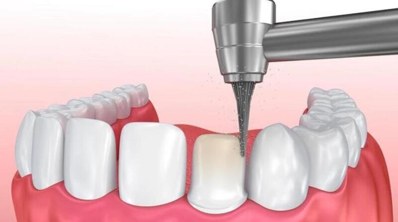 Mài răng bọc sứ