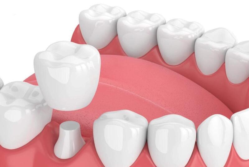 Bọc răng sứ chuẩn y khoa đảm bảo an toàn, tính thẩm mỹ và độ bền